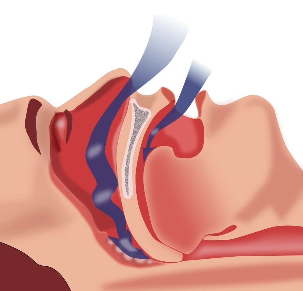 This diagram shows what happens to a Sleep Apnea patient during sleep. As a form of Obstructive Sleep Apnea treatment, CPAP therapy has been praised by many.